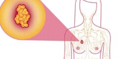 سرطان الثدي اعراضه و طرق العلاج
