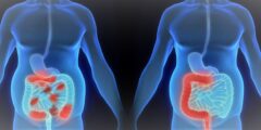 سرطان القولون و المستقيم – أعراضه و طرق علاجة و مراحل تطوره بالتفصيل